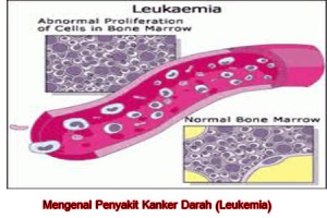 kanker-darah-leukemia